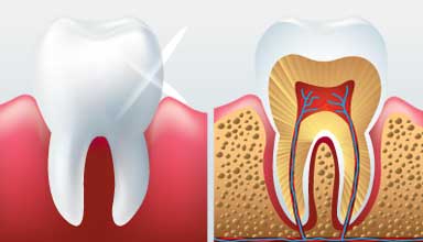 Examples of teeth with periodontitis in need of gum disease treatment