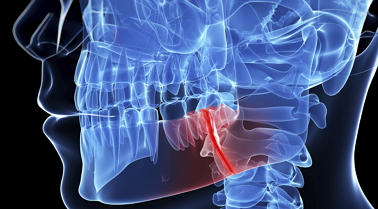 Digital image of patient's jaw bone fracture injury. Jaw surgery will be needed.