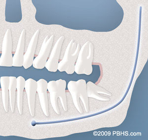 partial bony - UT Dentistry - San Antonio