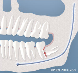 wisdom tooth cyst formation
