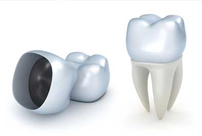 Crown lengthening for teeth where remaining structure is not exposed enough above the gum line.